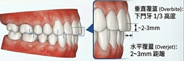 側面檢視(理想的牙齒咬合):垂直覆蓋(Overbite):下門牙 1/3 高度,約 2–3mm;水平覆蓋(Overjet):2~3mm 距離。